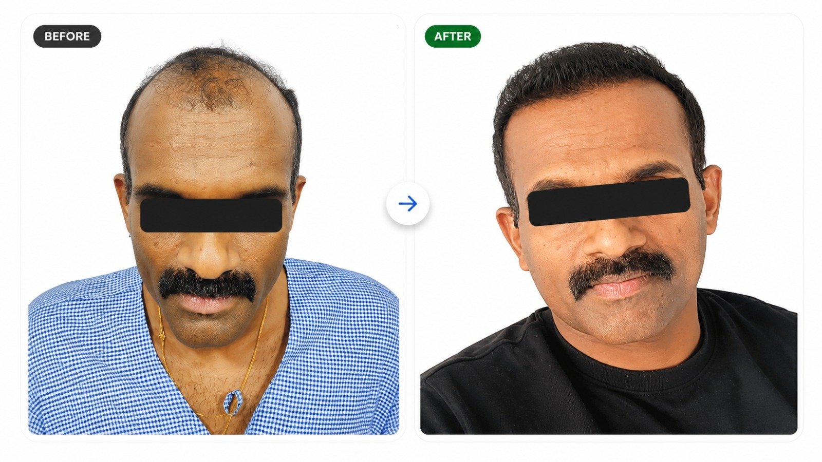 Patient 5 Before and After Hair Transplant